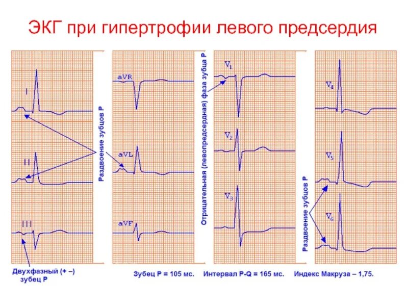 Гипертрофия желудочков на ЭКГ. Правожелудочковая гипертрофия ЭКГ. ЭКГ при гипертрофии левого правого желудочка. Гипертрофия левого предсердия на ЭКГ. Миокард левого предсердия