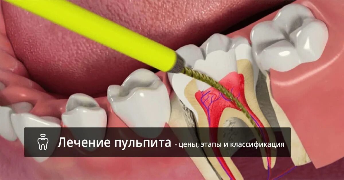 острый диффузный пульпит клиника. язвенно некротический пульпит. строение пульпы зуба и периодонта. пульпит корневого канала. строение зуба кариес пульпит.