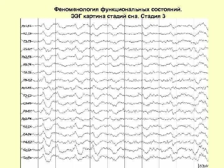 Фазы сна на ЭЭГ. Дельта сон на ЭЭГ. Поверхностные фазы сна ЭЭГ. Картина ЭЭГ фазы быстрого сна.