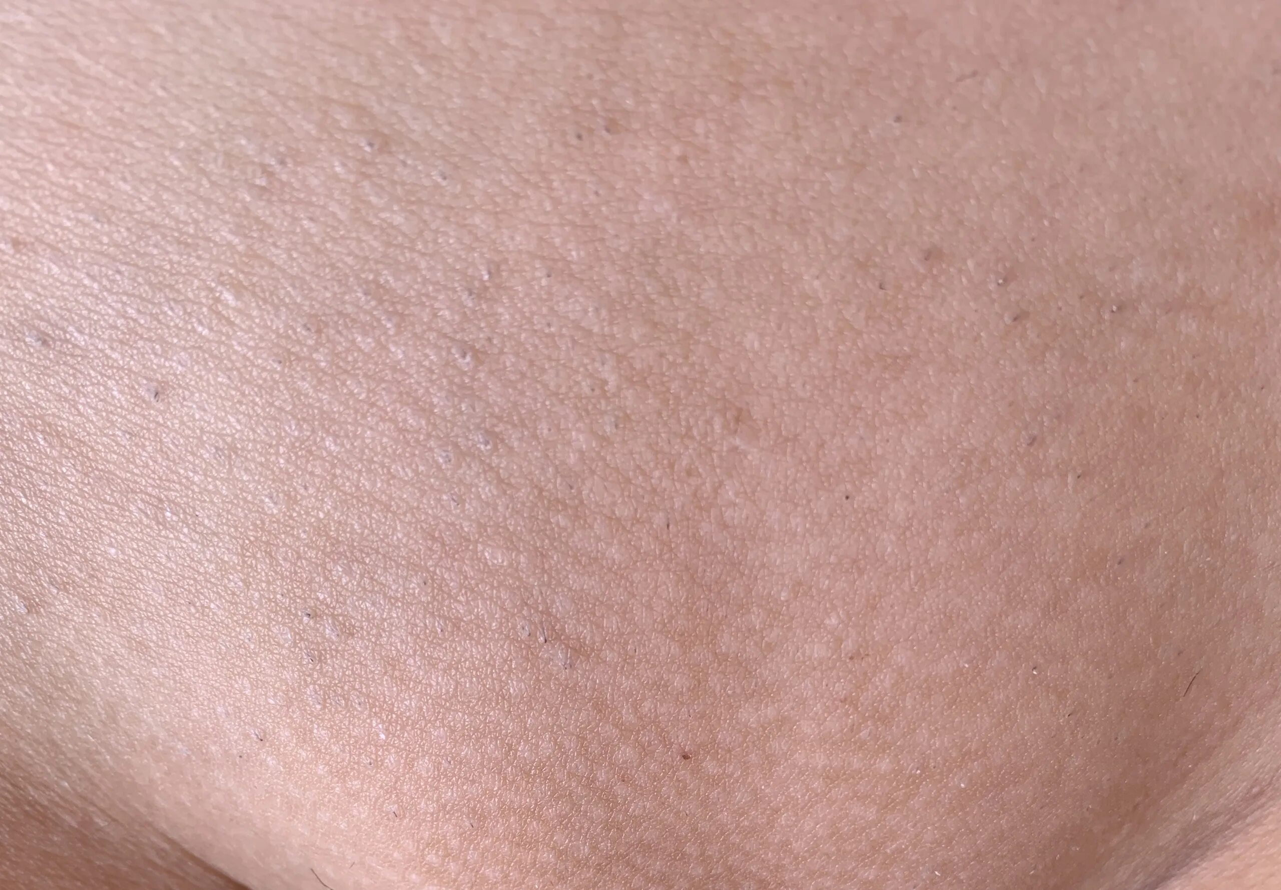 Лазерная эпиляция диодным лазером. Карбоновый пилинг фото. Лазерная эпиляция тамбов. Лазерная эпиляция тамбов. Лазерная эпиляция тамбов.