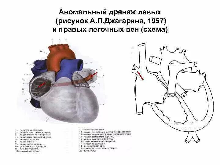 Аномальный дренаж. Аномальный дренаж легочных вен клинические рекомендации. Частичный аномальный дренаж легочных вен у новорожденных эхокг. Аномальный дренаж легочных вен схема. Аномальный дренаж.