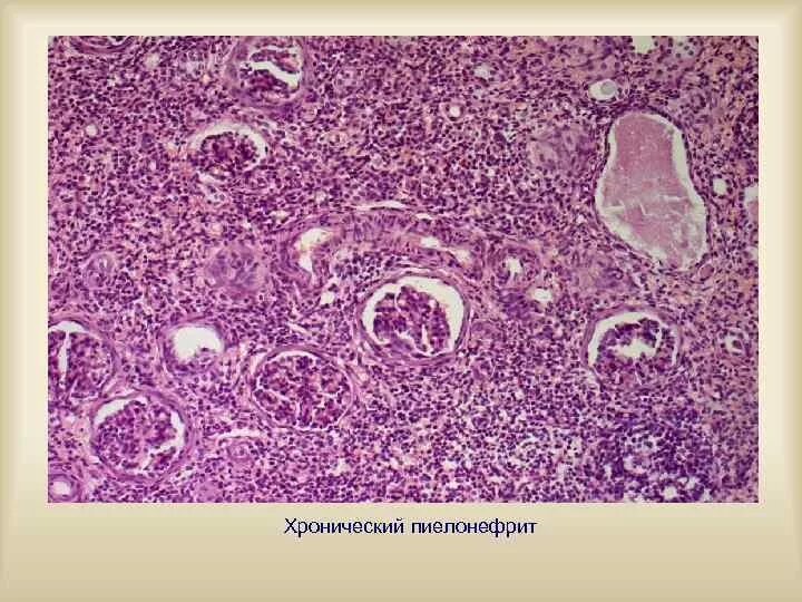 Пиелонефрит микропрепарат. Интерстициальный нефрит патанатомия. Хронический пиелонефрит патанатомия препарат. Хронический нефрит патанатомия. Фибропластический гломерулонефрит патанатомия.