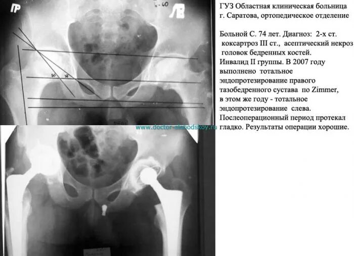 Инвалидность после эндопротезирования