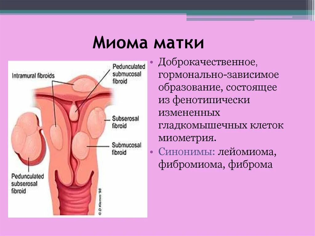 Лейомиома матки что это