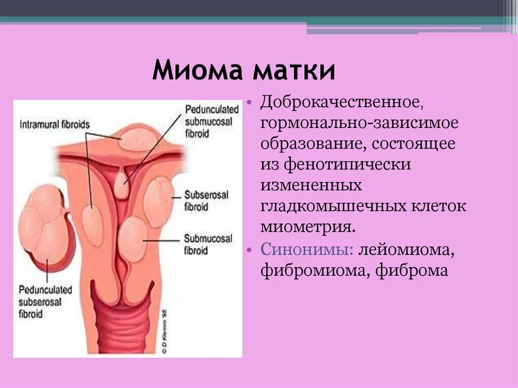 Локализация миоматозных узлов.