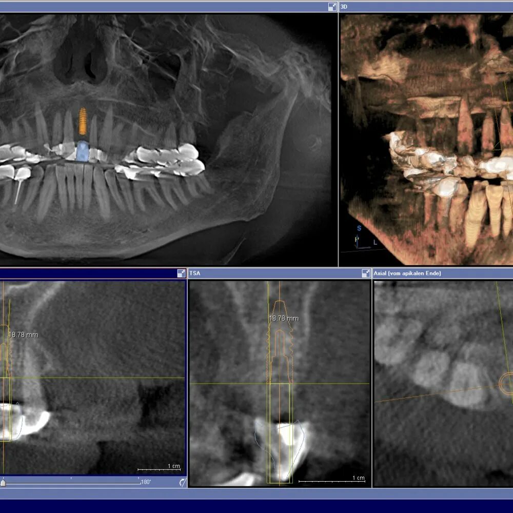 Имплант и мрт можно ли. Томография зубов Пикассо компьютерная. Кт зубов 3д Пикассо. Пикассо КЛКТ двух челюстей.