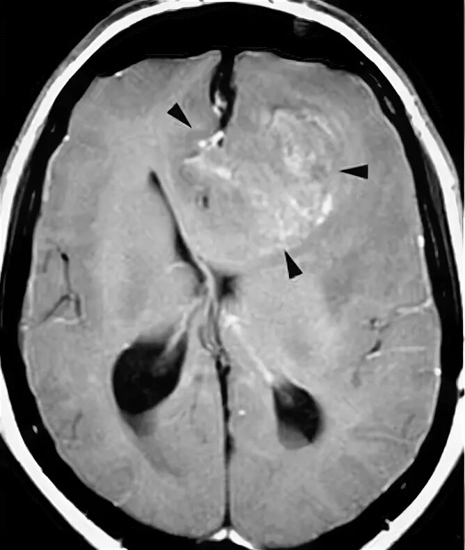 Пилоидная астроцитома. Мрт головного мозга т1 и т2. Диффузная астроцитома мрт. Диффузная астроцитома головного мозга мрт. Глиобластома на мрт с контрастом.