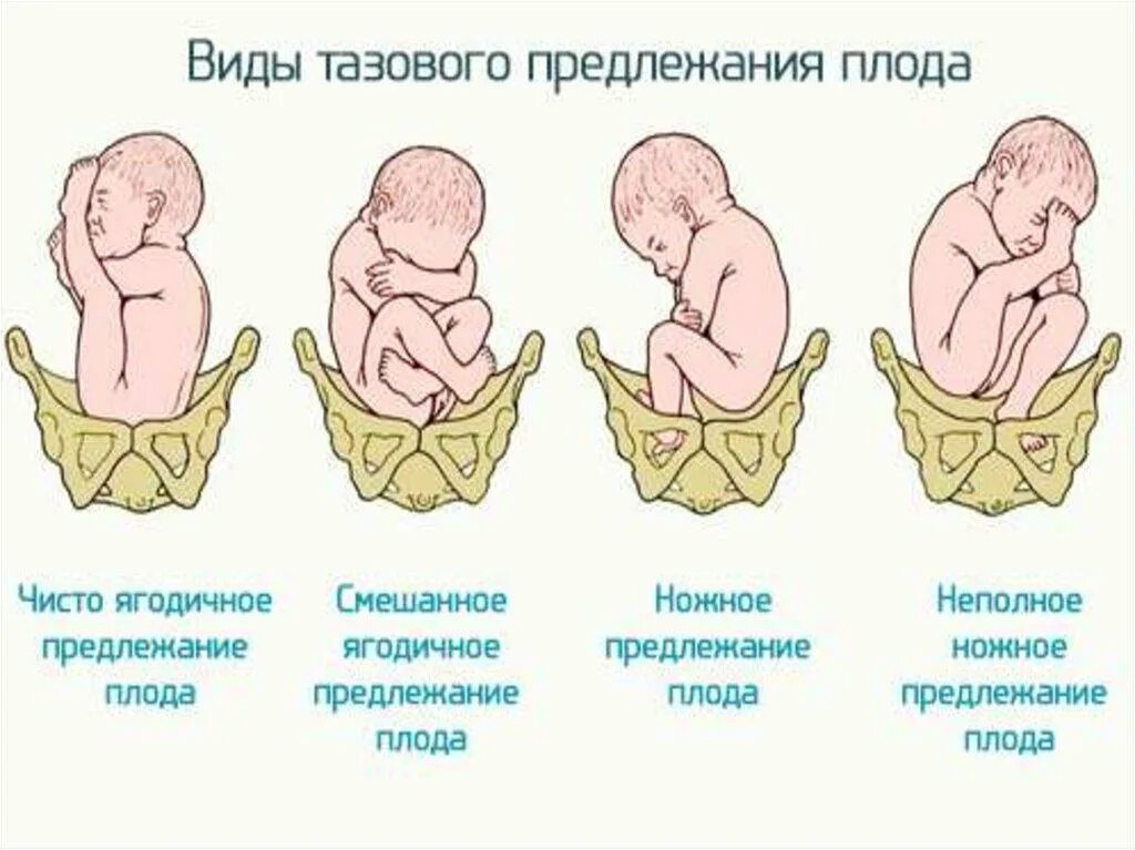 Какое должно быть предлежание. Положение плода продольное тазовое смешанное. тазовое ножное предлежание плода. ягодичное положение плода. ягодичное расположение плода.