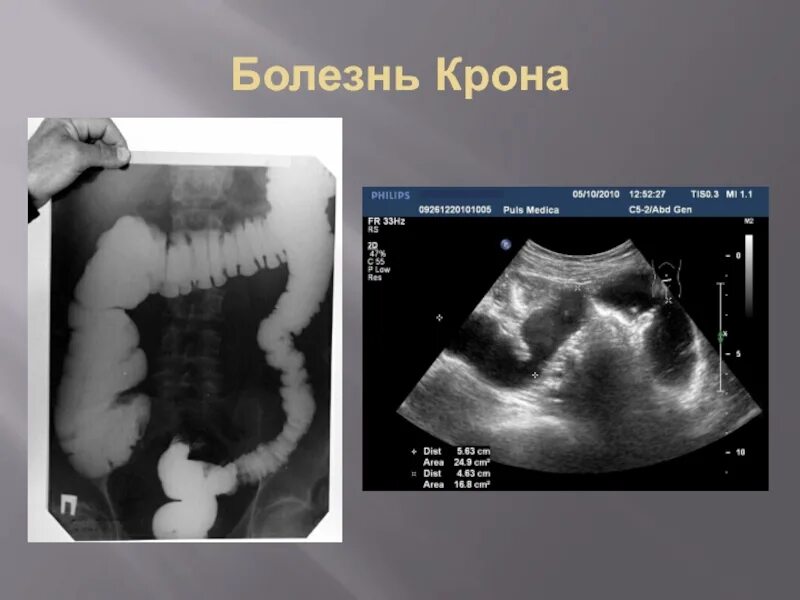 Болезнь крона как живете. Булыжная Мостовая рентген болезнь крона. Симптом булыжной мостовой болезнь крона рентгеноскопия. Рентген симптомы болезни крона.