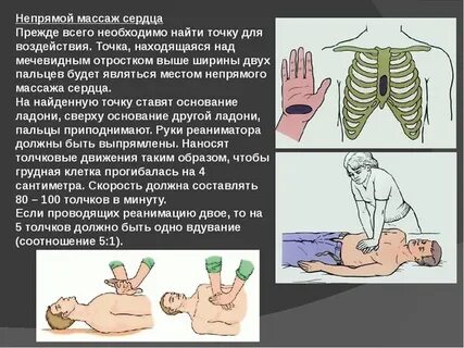 Смещение грудины при массаже сердца