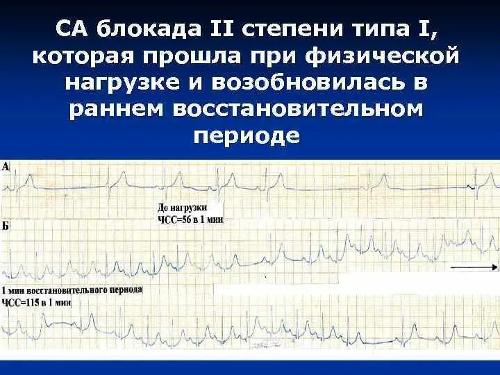 Са блокада 2 тип. Синоатриальная блокада 2 степени 1 типа. Са блокада 2 степени Мобитц 1. Синоаурикулярная блокада II степени. Са блокада II степени 1 типа.