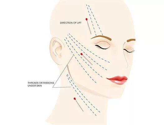 Схема подтяжки лица. Схемы постановки нитей на лице. Схемы введения мезонитей. Схема векторного лифтинга. Векторный лифтинг схема.