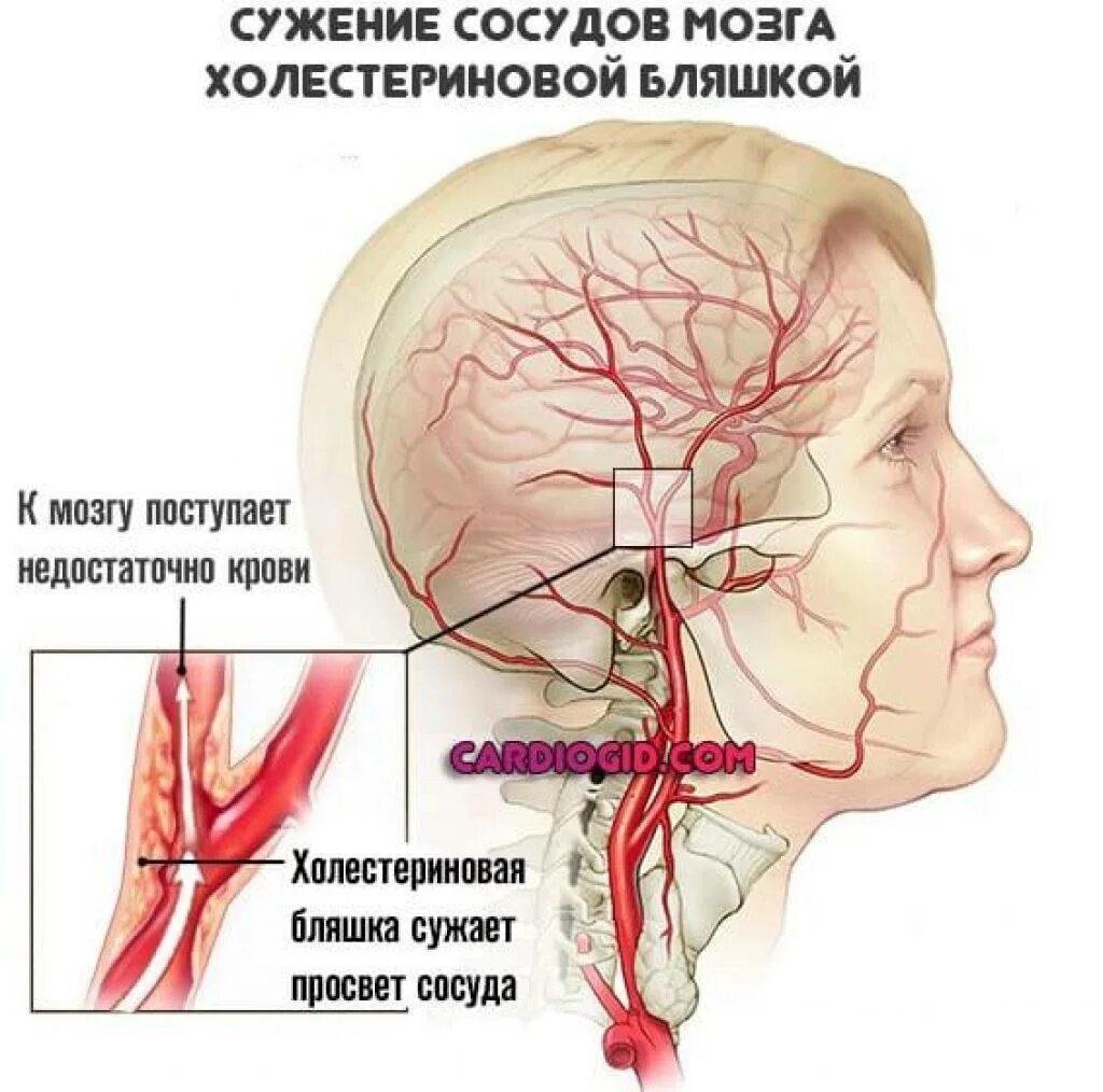 Закупорка головных сосудов. Ценноз церебральных артерий. Сужение сосудов головного мозга. Сужение артерий головного мозга.