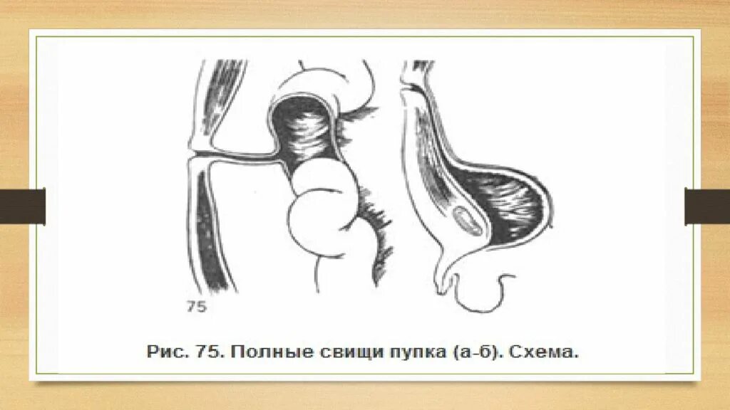 Международный день по искоренению акушерских свищей