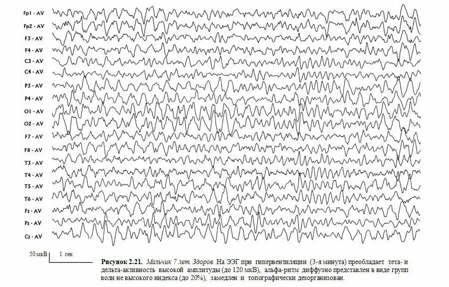 Структурная схема ЭЭГ. Электроды ЭЭГ чертеж. ЭЭГ норма. Возрастные особенности ЭЭГ У детей. Ээг тверь