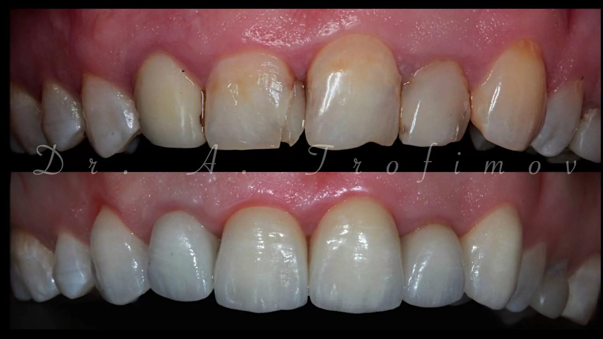 Стоматология наращивание зуба. Группа зубы. Искусственные зубы верхние премоляры. Группа нальчик. Группа зубы.