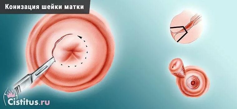 Форум эрозия шейки матки и беременность: Эрозия во время беременности…девченки,у