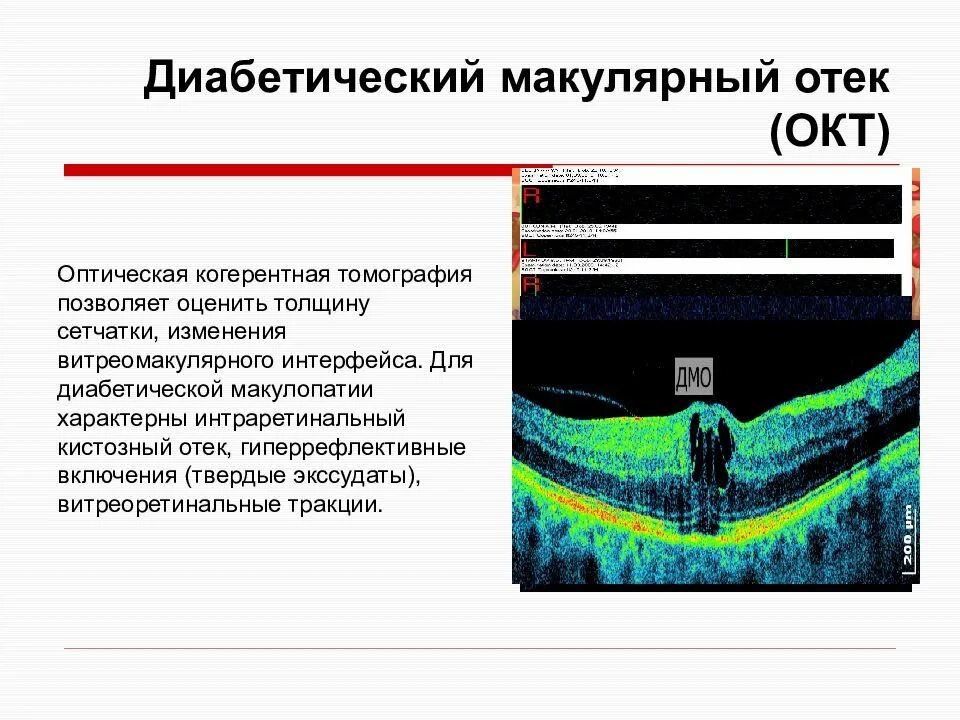 Макулярный отек лечение. Диабетический макулярный отек. Тракционный макулярный отек. Оптическая когерентная томография диабетический макулярный отек.