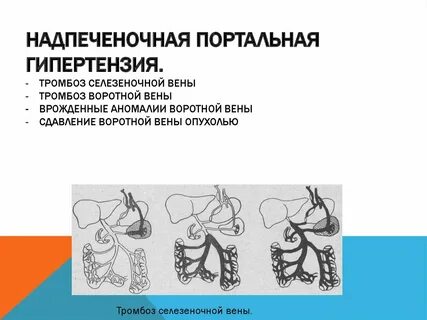 Тромб в воротной вене