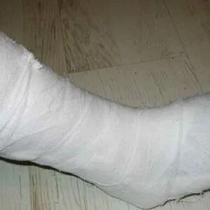 Гипсовая повязка сапожок