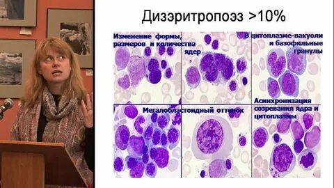 Миелодиспластический синдром по утвержденным клиническим