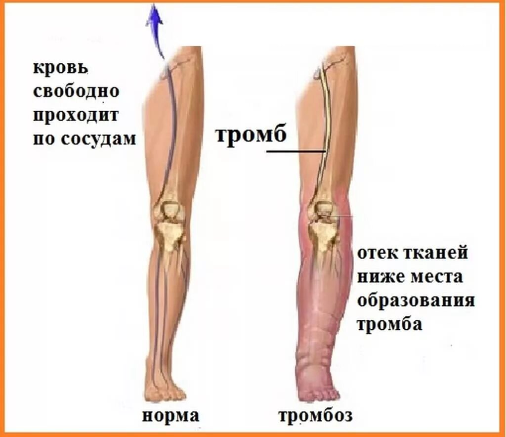 Тромбофлебит вен конечностей симптомы. Тромбоз глубоких вен нижних конечностей. Флеботромбоз голени клиника. Размеры тромбов