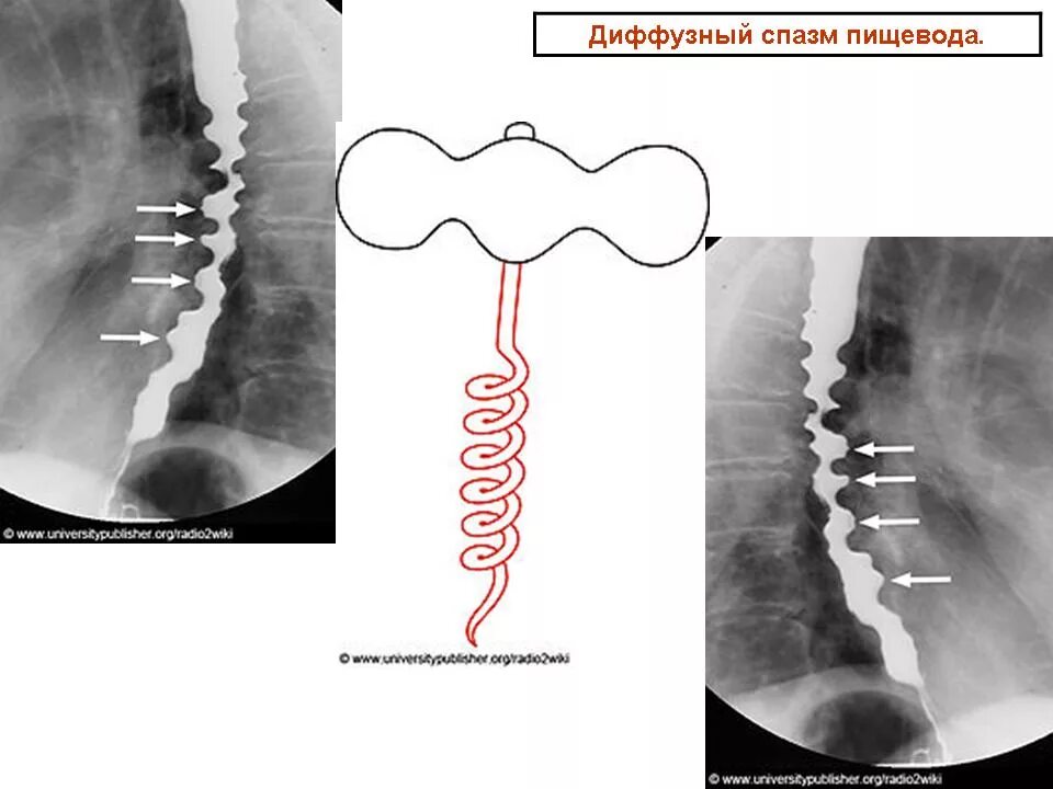 Диффузионный спащм пищевода. Диффузный эзофагоспазм. Диффузный спазм пищевода. Диффузный спазм пищевода рентген. Синдром пищевода