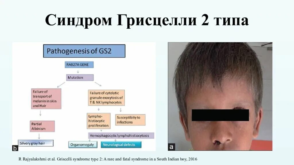 Два синдром. Гемофагоцитарного синдрома. синдрома грисцелли 2 типа?. синдром германского-пудлака.