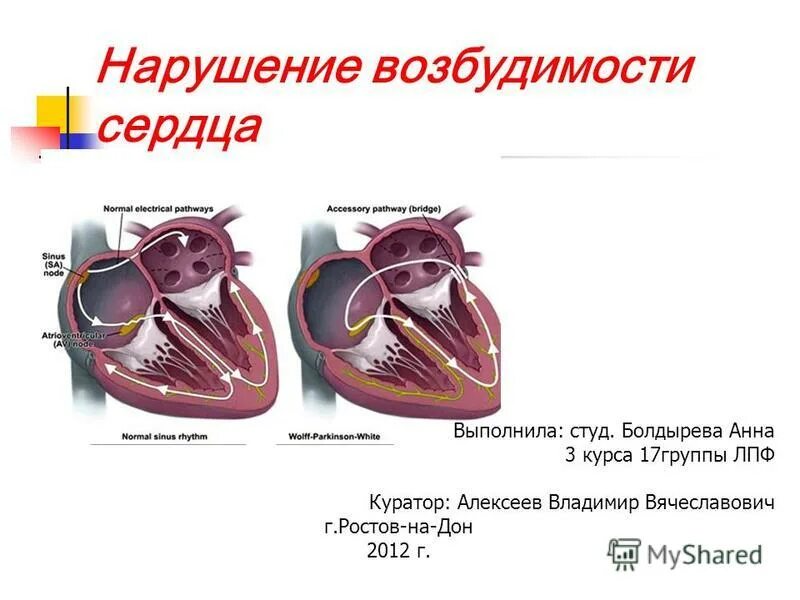 Возбудимость сердца это. Нарушение возбудимости сердца. проводящая система сердца. нарушения функции возбудимости. нарушение функции возбудимости миокарда.
