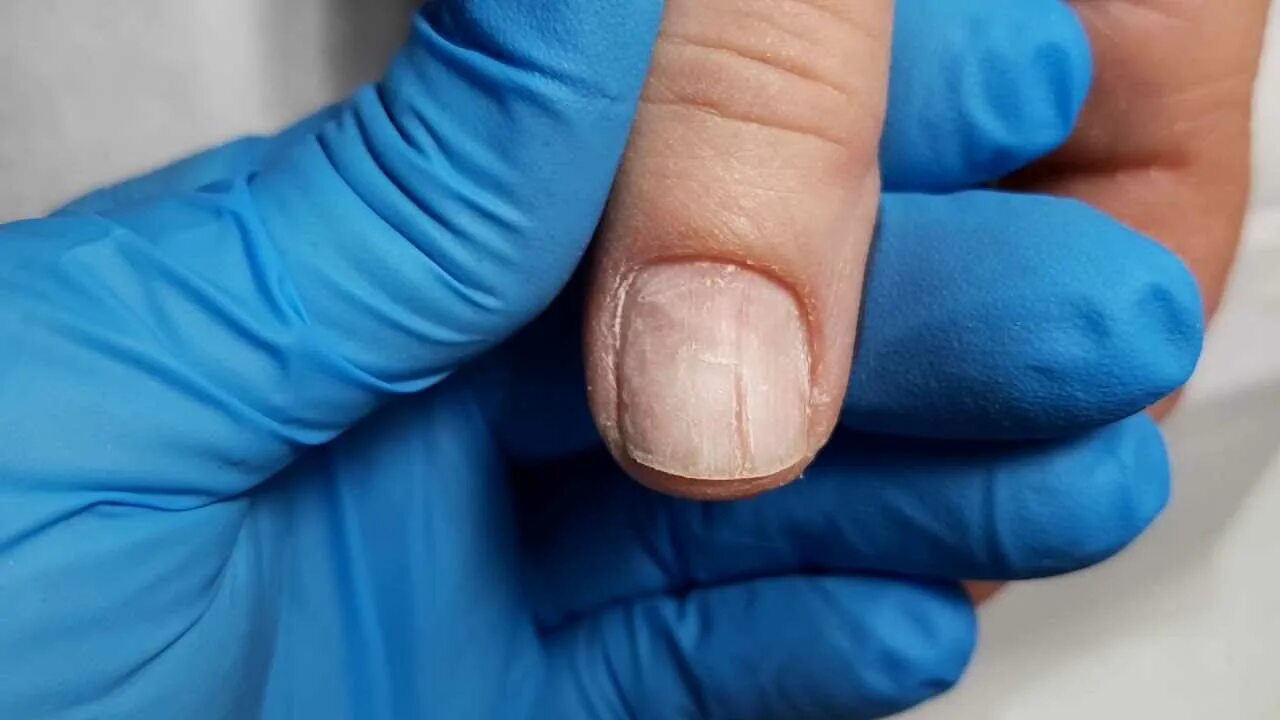 Ониходистрофия - онихолизис.. Ониходистрофия (дистрофия ногтей). Травмирование ногтевой пластины.