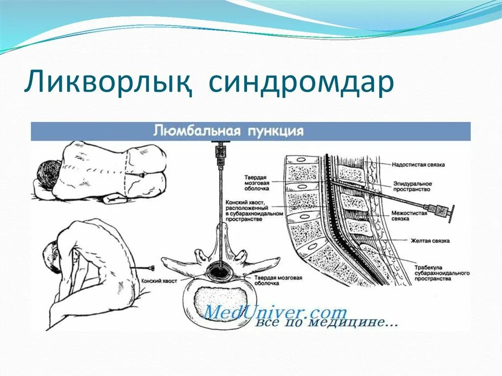 Люмбальная пункция техника. Протокол проведения люмбальной пункции. Методика выполнения люмбальной пункции. Катетер для люмбальной пункции.