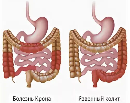 Илеоколит. Болезнь крона и неспецифический колит. Язвенный колит кишечника. Неспецифический язвенный колит.