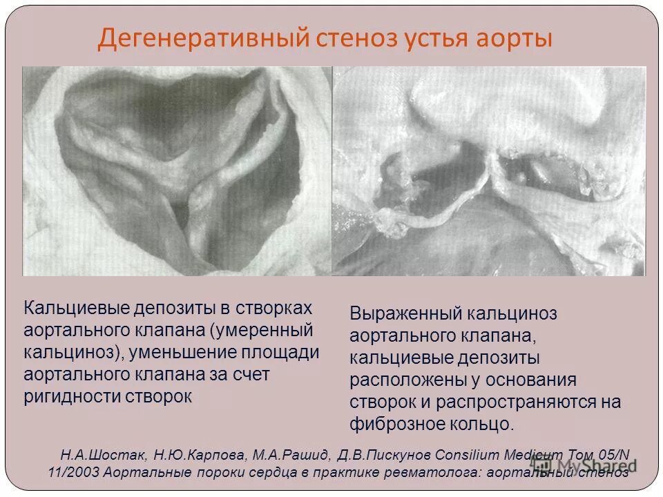 Дегенеративный аортальный стеноз. Кальцификация створок аортального клапана. Дегенеративный артериальный стенозж. Кальцинированный аортальный клапан.