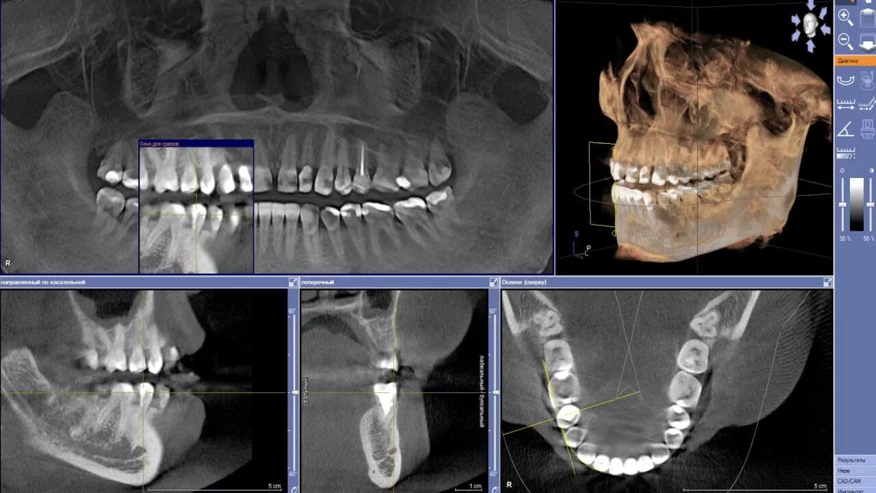 Кт 3д зубочелюстной системы. Ортопантомография ВНЧС. Кт д т