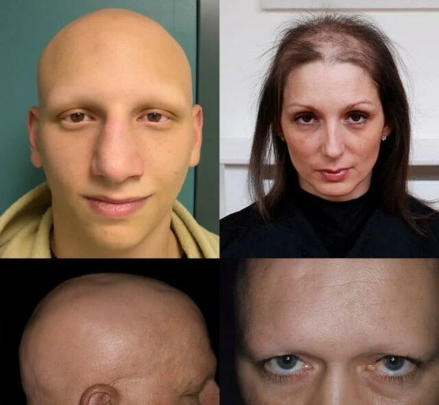 Какие волосы после химиотерапии. Тотальная алопеция у женщин. Человек без бровей и ресниц.