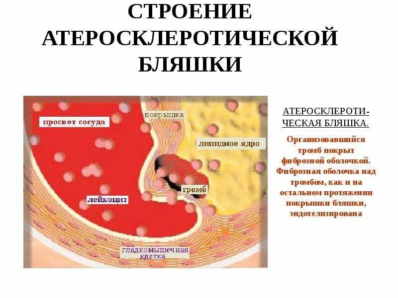 Что такое атеросклеротические бляшки. Атеросклеротическая бляшка. морфология атеросклеротической бляшки. строение атерослеротической бляшк.