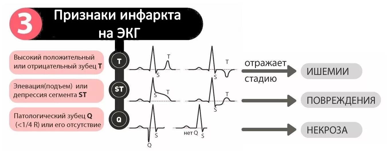 Изменение зубца q. Инфаркт показатели на ЭКГ зубец q. Инфаркт миокарда зубцы на ЭКГ. Патологический зубец q на ЭКГ при. Зубец q в v3 на ЭКГ.