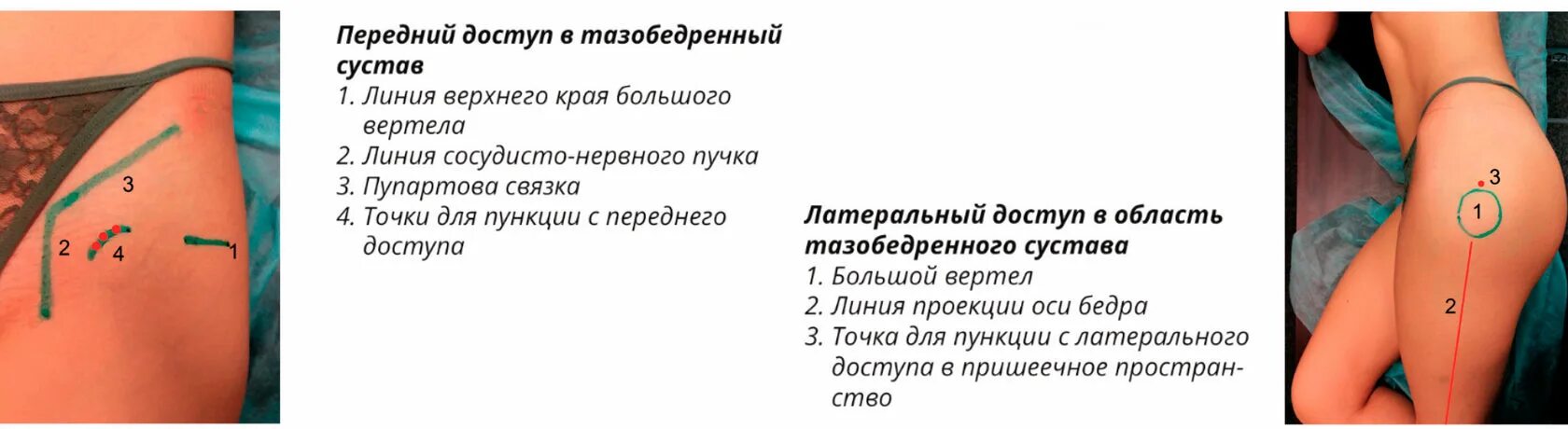 Пункция тазобедренного сустава техника выполнения. Тазобедренный сустав блокада укол. Пункция тазобедренного сустава, блокады. Методика пункции тазобедренного сустава. Ориентиры пункции тазобедренного сустава.