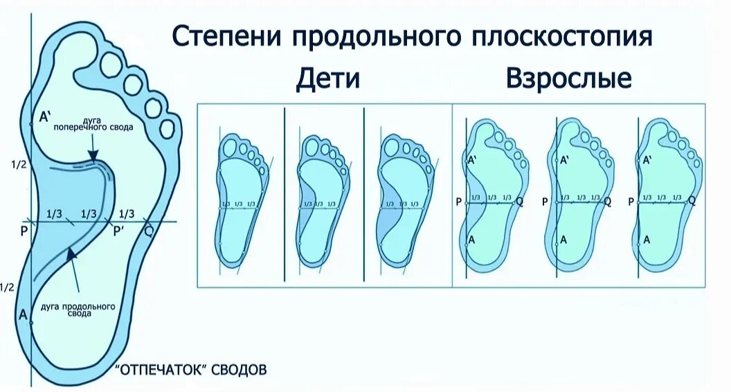 Поперечное плоскостопие ii степени. Стопа с 1 степенью плоскостопия. Продольное поперечное и комбинированное плоскостопие. Поперечное плоскостопие 4 степени. Продольно-поперечное плоскостопие и вальгус 3 степени.