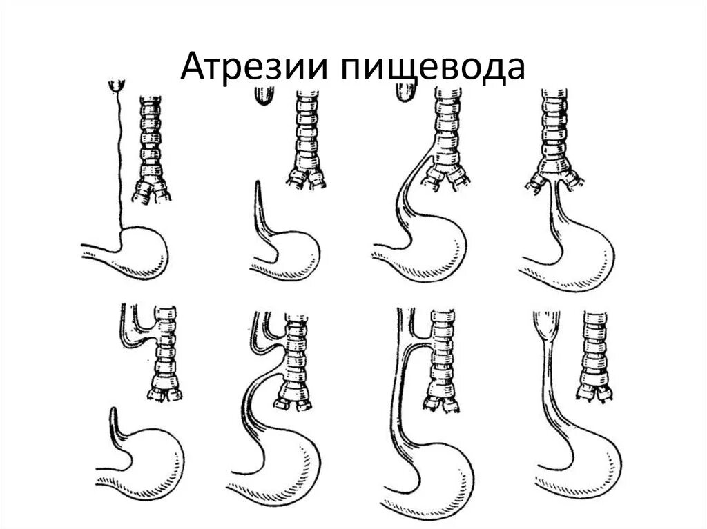 Врожденные пороки развития пищевода. Врожденная патология пищевода. Классификация Гросса атрезия пищевода. Врожденные пороки развития пищевода классификация.