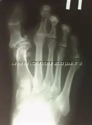 Эндопротезирование сустава стопы. Эндопротез таранной кости. Остеоартрит голеностопного сустава. Ортродез стоп ренентген. Эндопротезирование сустава стопы.