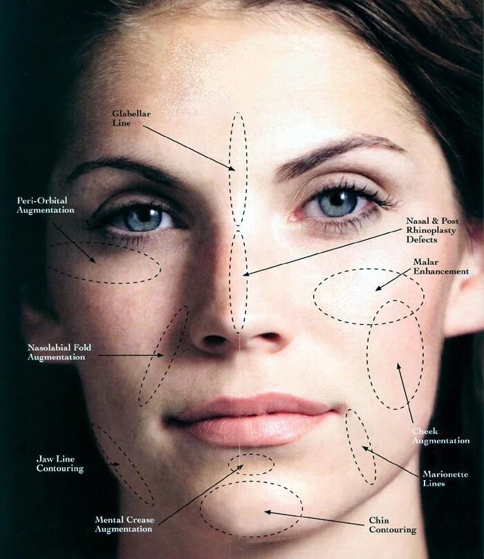 филлеры на основе гиалуроновой кислоты для лица. точки введения ботокса схема. куда колят филлеры. зоны для ботокса на лице. схема введения диспорта в лоб.