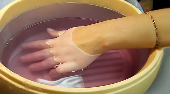 подкожный панариций разрез. подкожный панариций клюшкообразный разрез. руки в тазике с водой. подошвенная вода. ванночки для пальцев.