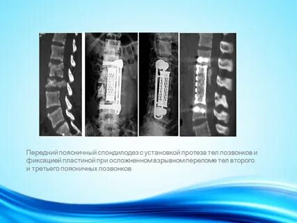 Передний спондилодез