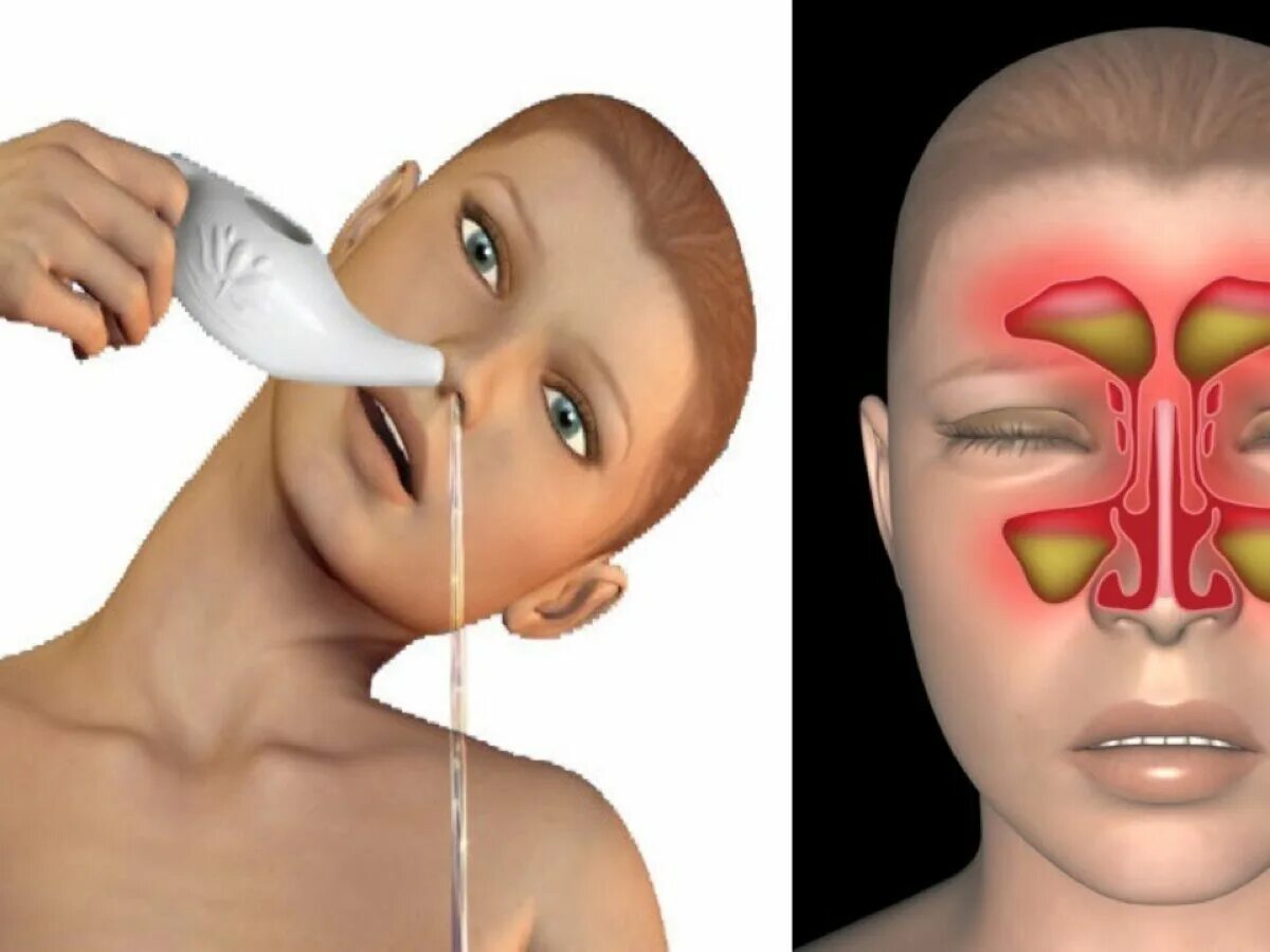 Греть нос при заложенности. Двухсторонний синусит. Воспаление придаточных пазух носа.