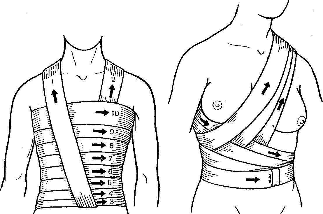 Повязка на молочные железы алгоритм. Техника наложения окклюзионной повязки на грудную клетку. Спиралевидная повязка на грудную клетку. Бинтовая повязка на грудную клетку. Наложение спиральной повязки на грудную клетку.