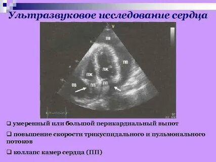 Выпот в перикарде