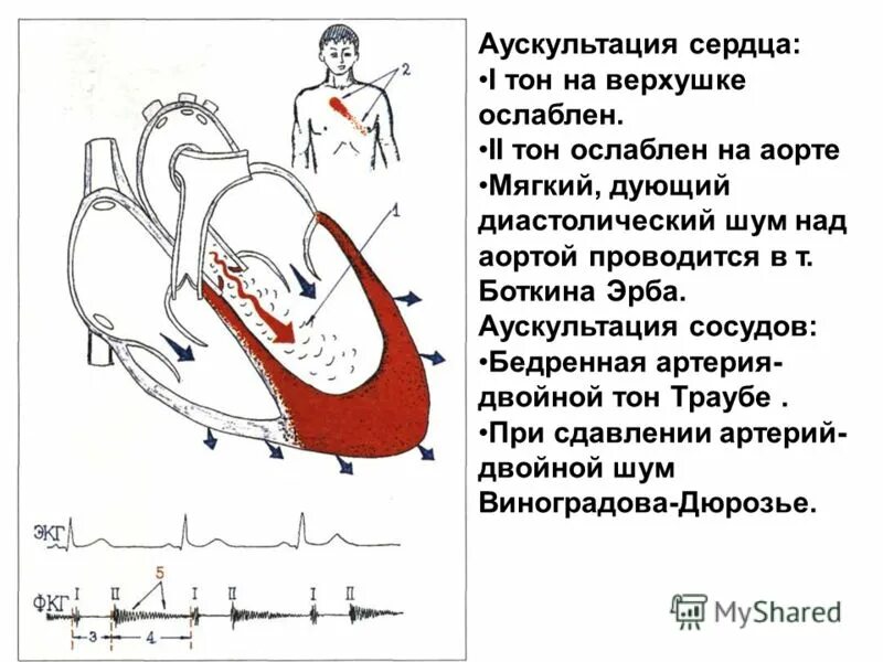 1 тон сердца при митральной недостаточности. недостаточность аортального клапана аускультация. шум митральной недостаточности экг. недостаточность клапана аорты аускультация.