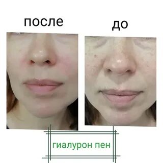 Hyaluron pen губы