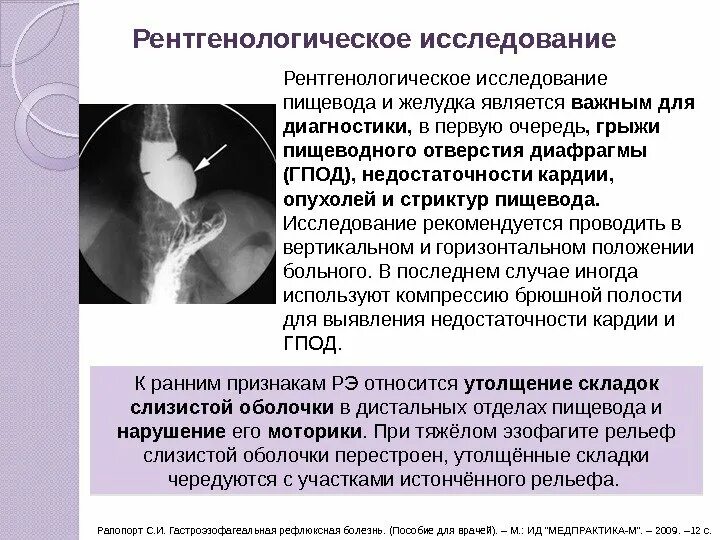 Как подготовиться к рентгену пищевода. Методика рентгенологического исследования пищевода. гастроэзофагеальный рефлюкс рентген. рентгенологическое исследование пищевода и желудка гэрб.